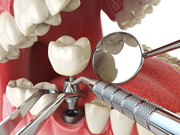 Best Chipped Tooth Repair Near Me  in Archbald, PA